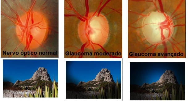 Glaucoma, sintomas e tratamento